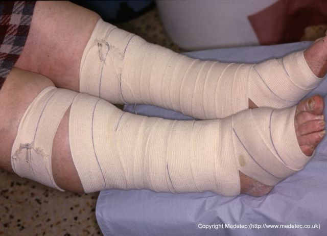 large compression bandage