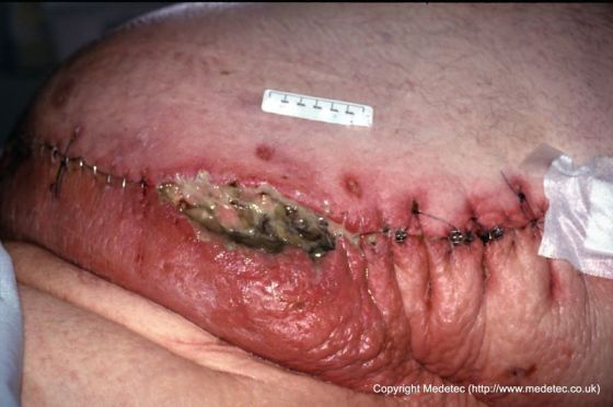 abdominal wound infection