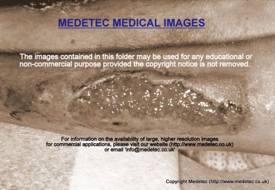 extravasation wound