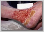 wound image