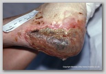 wound image