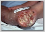 wound image