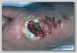 wound image