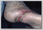 wound image