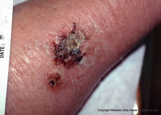 Venous Skin Ulcer-Topic Overview - WebMD