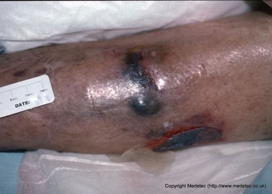 leg ulcer