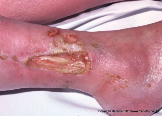 leg ulcer