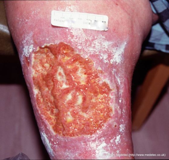 leg ulcer