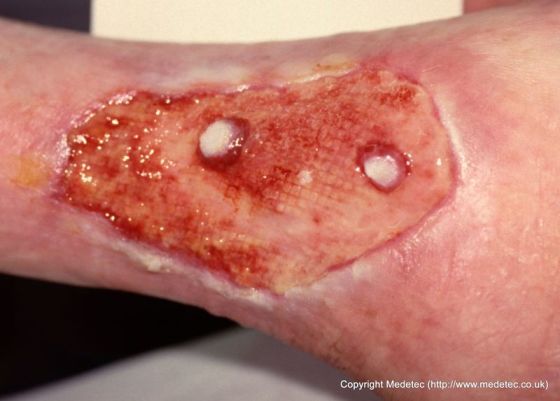 leg ulcer