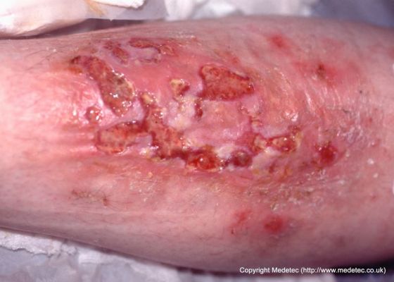 leg ulcer