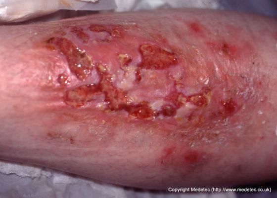 leg ulcer