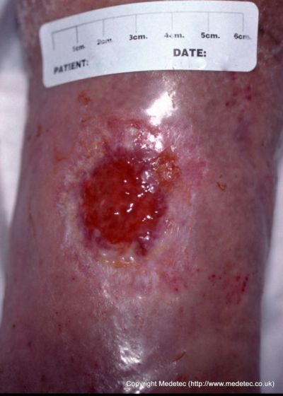 leg ulcer