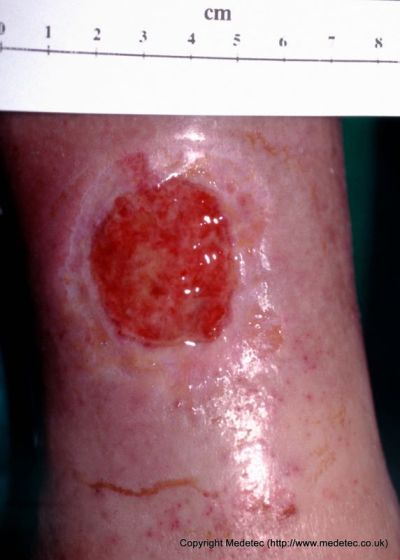 leg ulcer