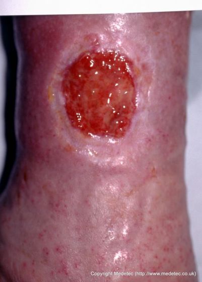 leg ulcer