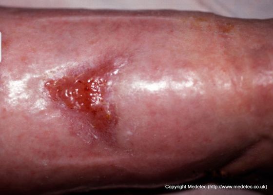 leg ulcer