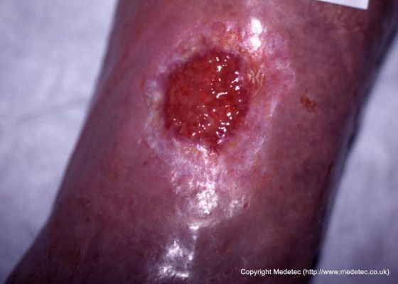 leg ulcer