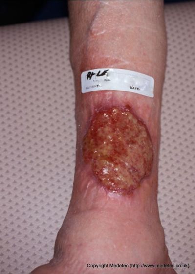 leg ulcer