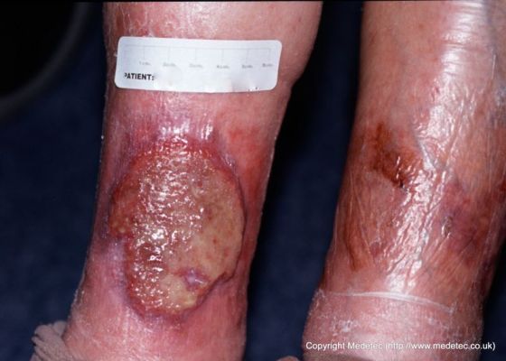 leg ulcer