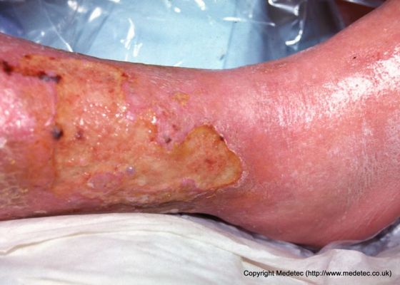 leg ulcer