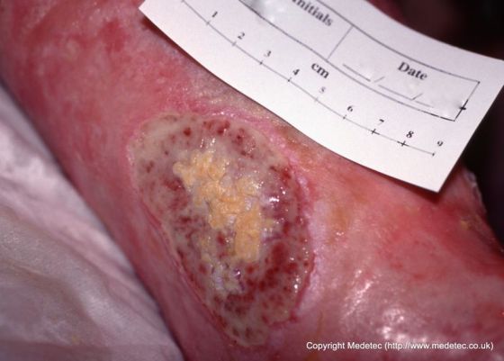 leg ulcer