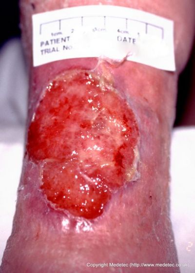 leg ulcer