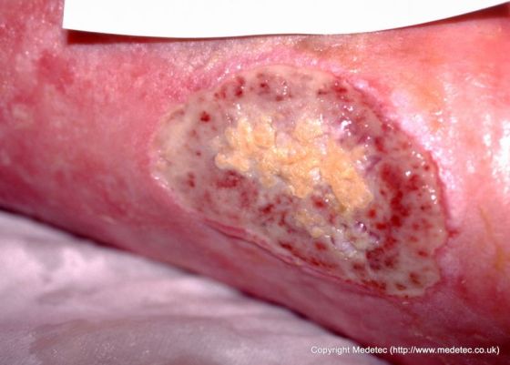 leg ulcer