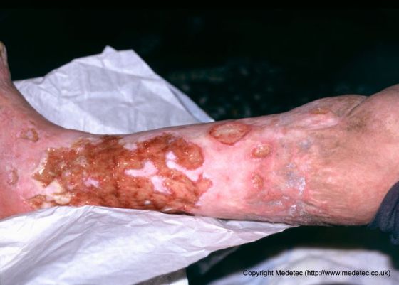 leg ulcer