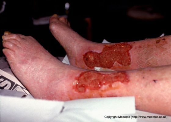 leg ulcer