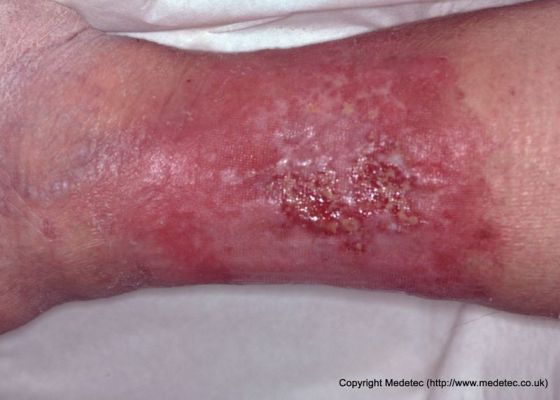 leg ulcer