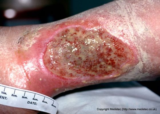 leg ulcer