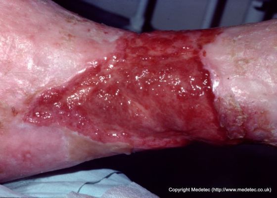 leg ulcer