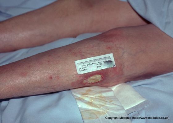 leg ulcer