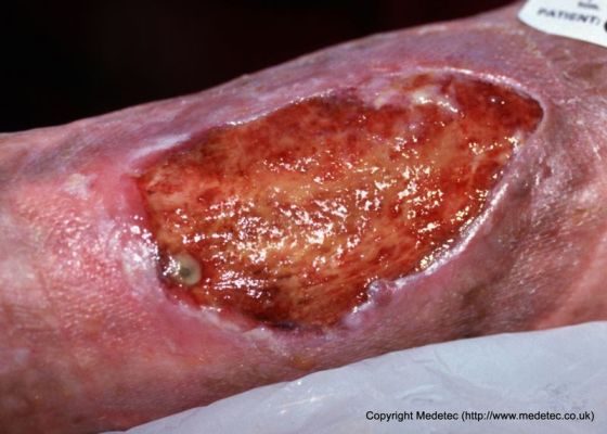 leg ulcer