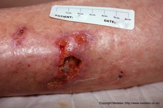 leg ulcer