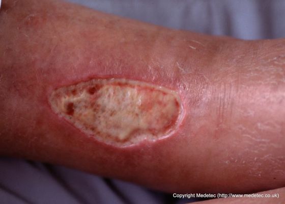 leg ulcer