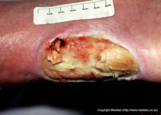 leg ulcer