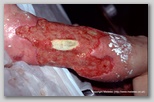 leg ulcer