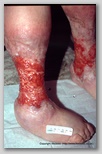 leg ulcer