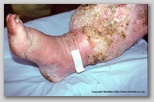 leg ulcer