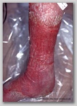 leg ulcer