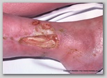 leg ulcer