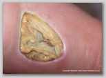 leg ulcer