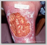 leg ulcer