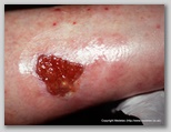 leg ulcer