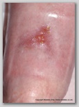 leg ulcer