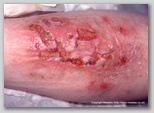 leg ulcer