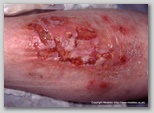 leg ulcer