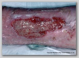 leg ulcer