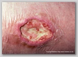 leg ulcer