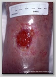 leg ulcer